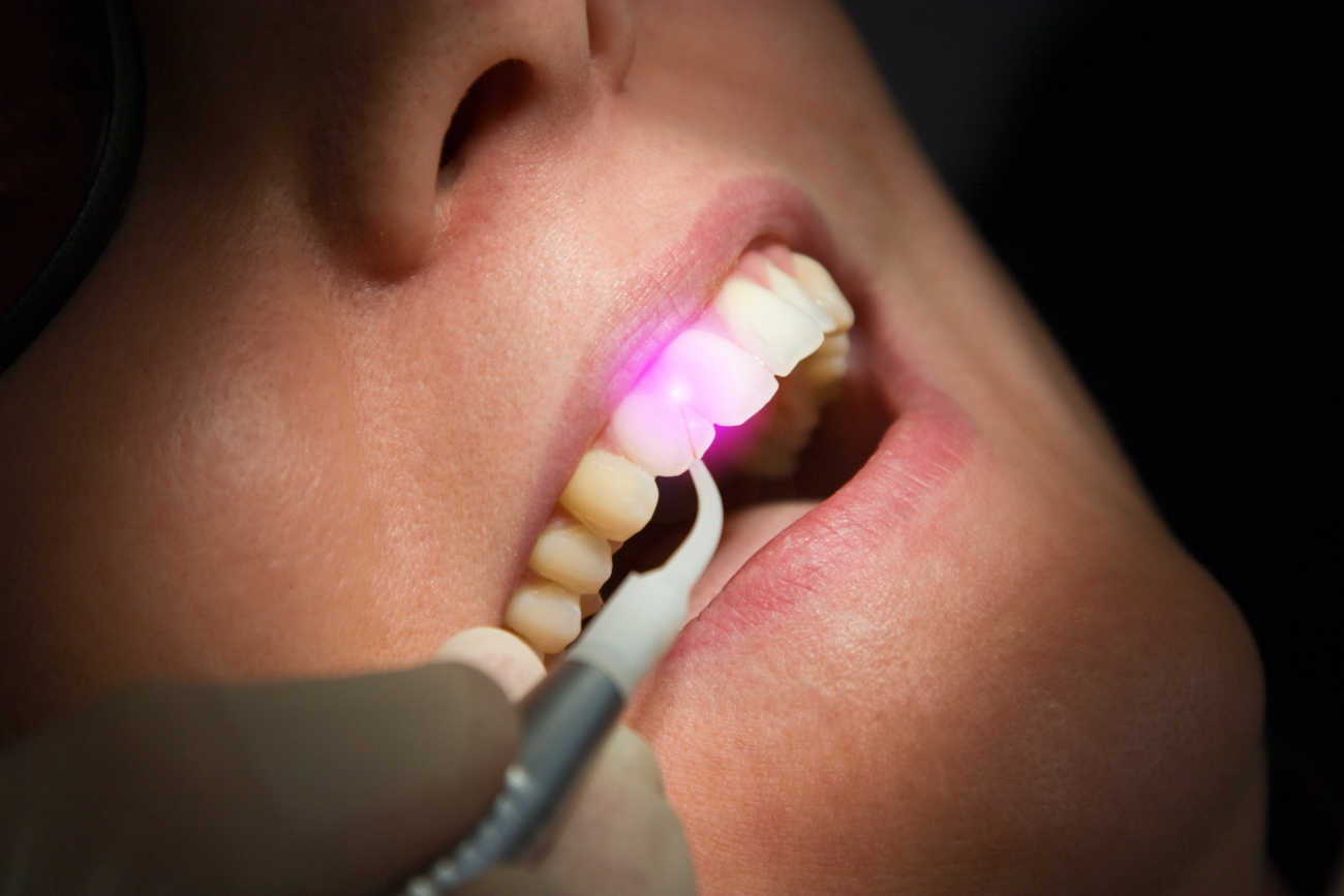 Domande frequenti e curiosita sulla laser terapia dentale 