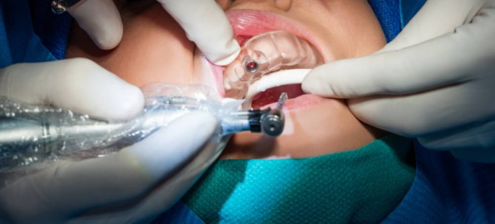 La stampa 3D nellindustria dentale
