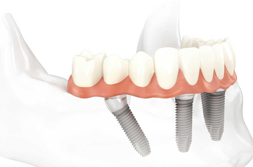 all on 4 treatment 2