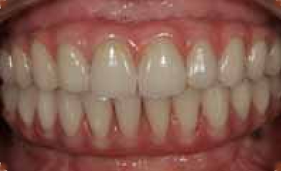 all on 4 treatment after