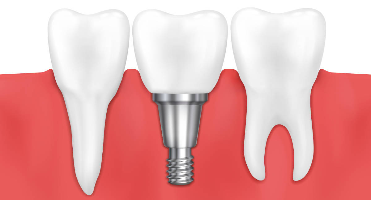 impianti dental smile clinic