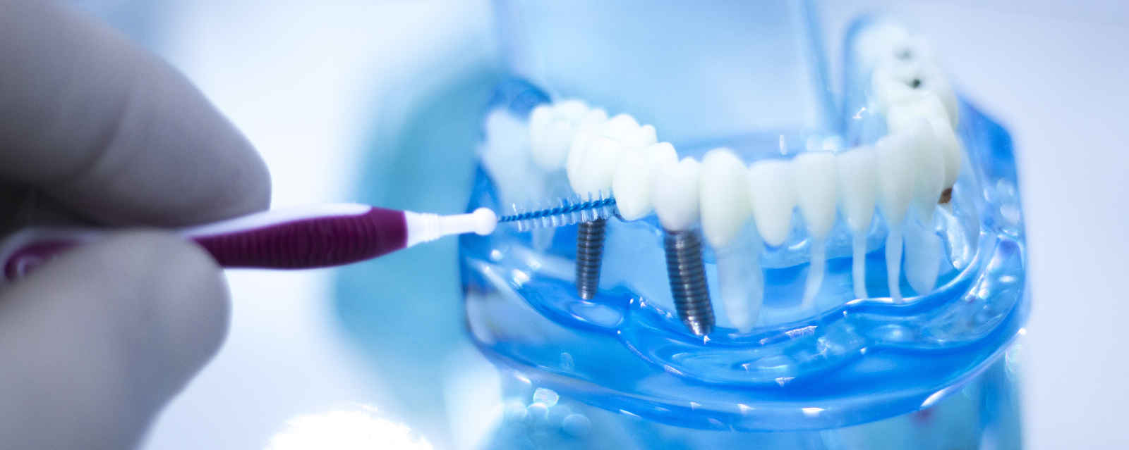 Gli impianti dentari sono delle viti in titanio