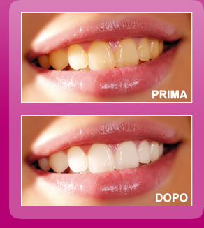 sbiancamento dentale1