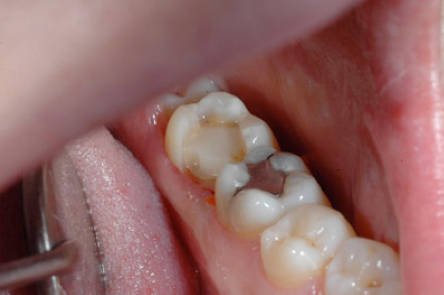 intarsio tecnica Indiretta di ricostruzione del dente