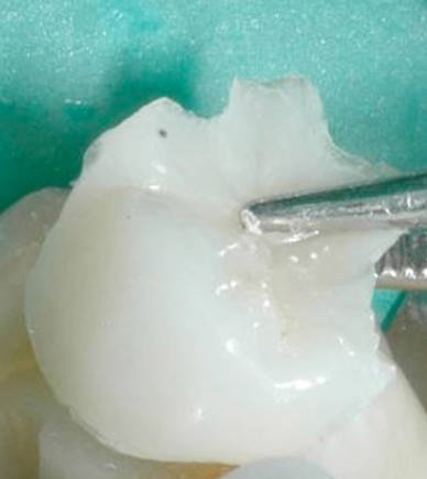 intarsio ricostruito in ceramica dallodontotecnico