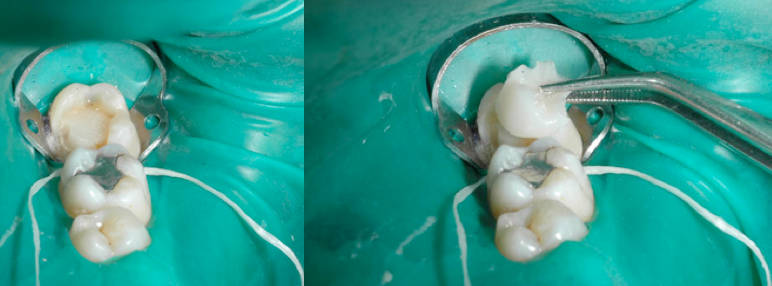 intarsio viene posto in opera nel dente