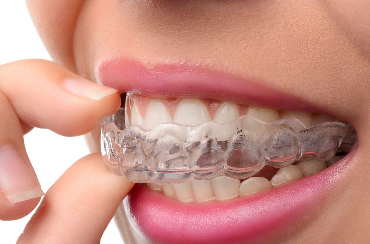 Allineatore invisibile come Invisalign® - Dental Smile Clinic