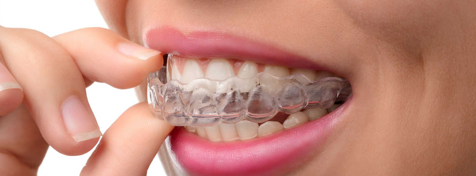 L'apparecchio invisibile Invisalign®