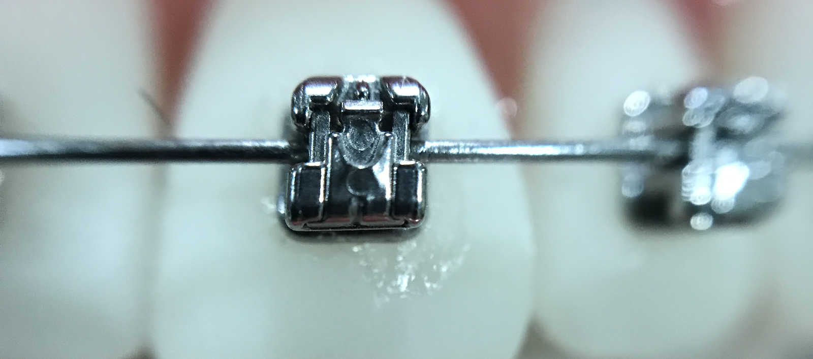 100 Confezioni Fili Arco Ortodonzia Dentale Acciaio Inox Forma