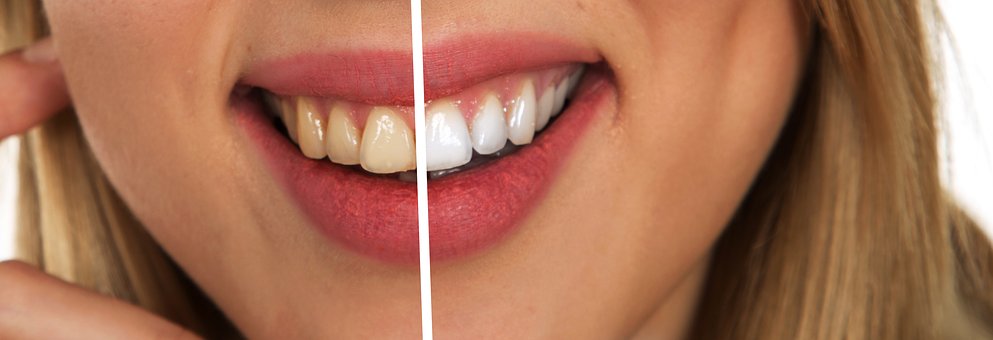 Sbiancamento dei denti